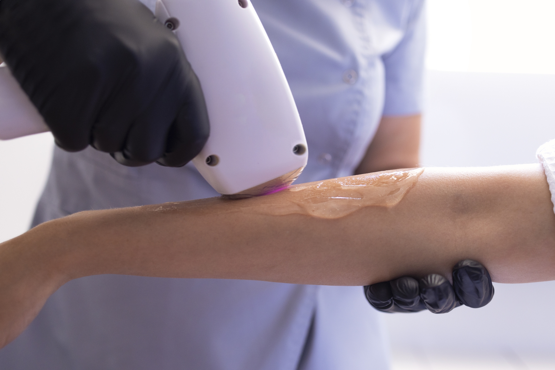 Epilazione definitiva con laser: è il momento di dire addio ai peli superflui